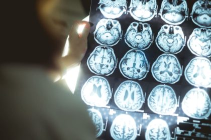 Are You at Risk For Huntington’s Disease