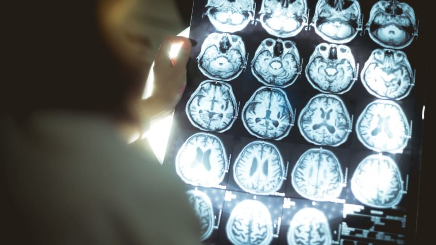 Are You at Risk For Huntington’s Disease