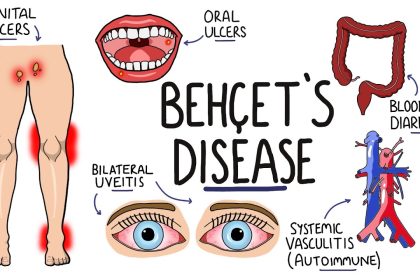 Behcet's Disease