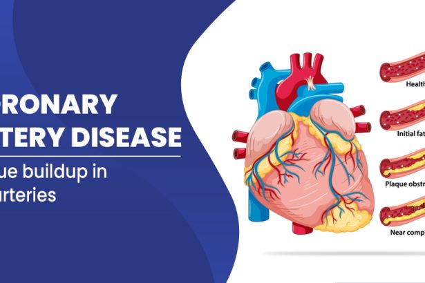 Coronary Artery Disease