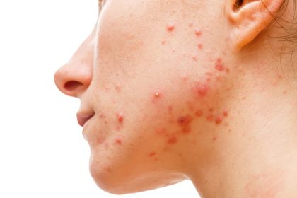Cystic Acne Treatment in Pakistan