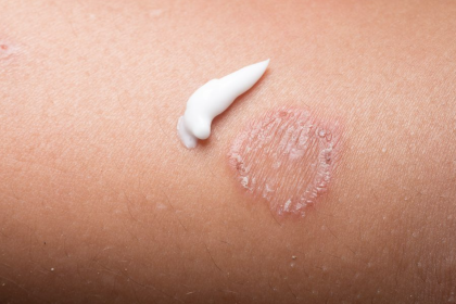 Fungal Skin Infections