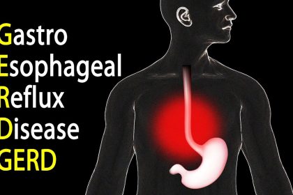 Gastroesophageal Reflux Disease