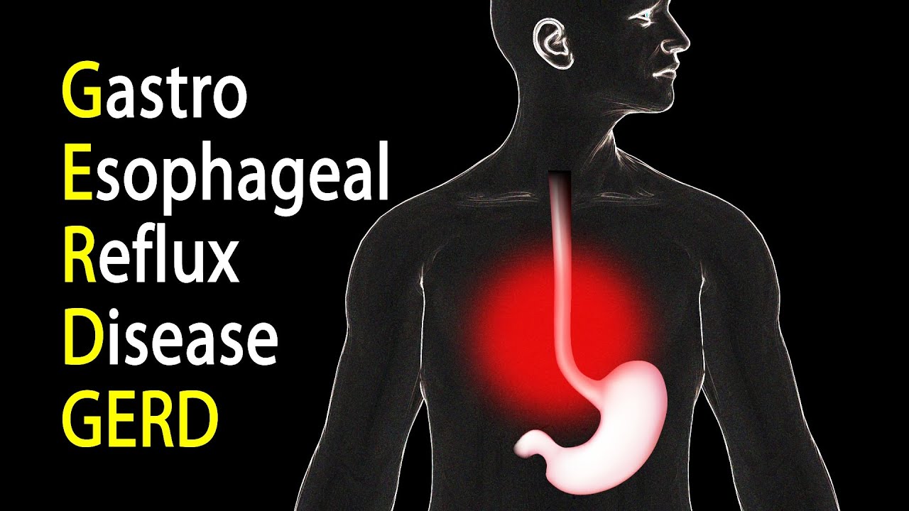 Gastroesophageal Reflux Disease