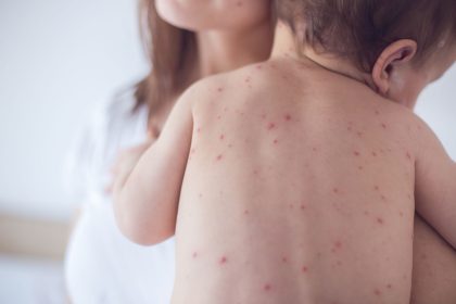 How to Diagnose Measles