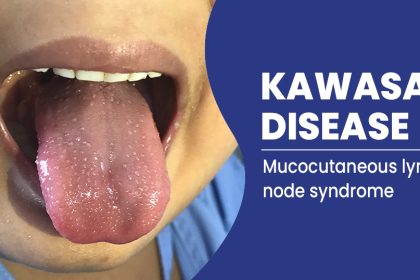 How to Manage Kawasaki Disease