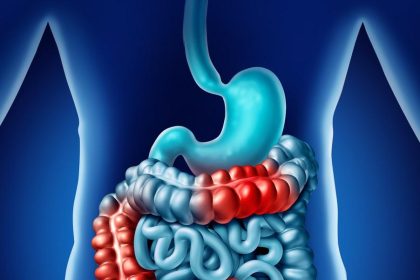 Inflammatory Bowel Disease