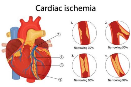 Ischemic Heart Disease