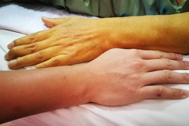 Jaundice Yellow Skin