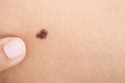 Moles - Symptoms and Causes