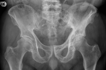 Pagets Disease
