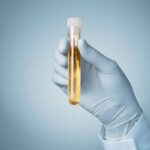 Pus Cells in Urine