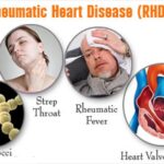 Rheumatic Heart Disease - Symptoms and Treatments