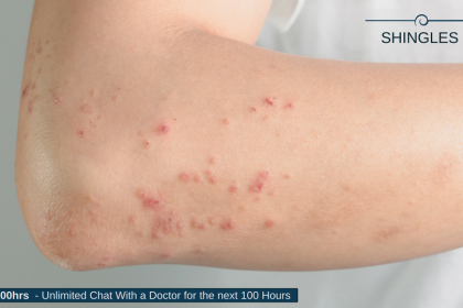 Shingles Symptoms, Causes, and Complications