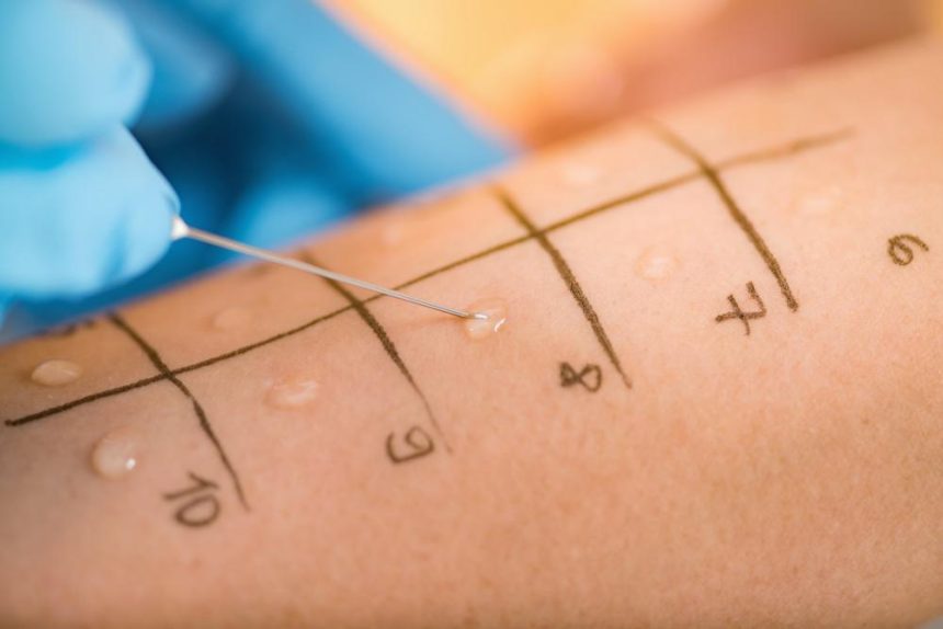 Skin Allergy Testing