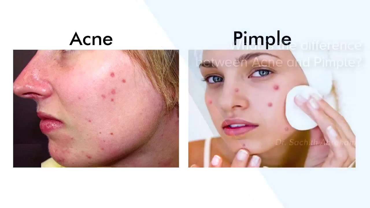 The Difference Between Acne and Pimples - FAQs
