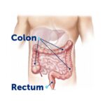 What Is Colorectal Cancer