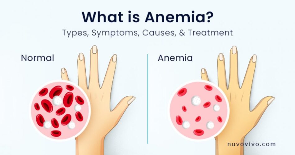 What is Anemia? FAQs