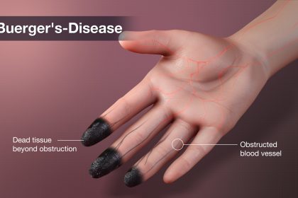 What is Buerger’s Disease