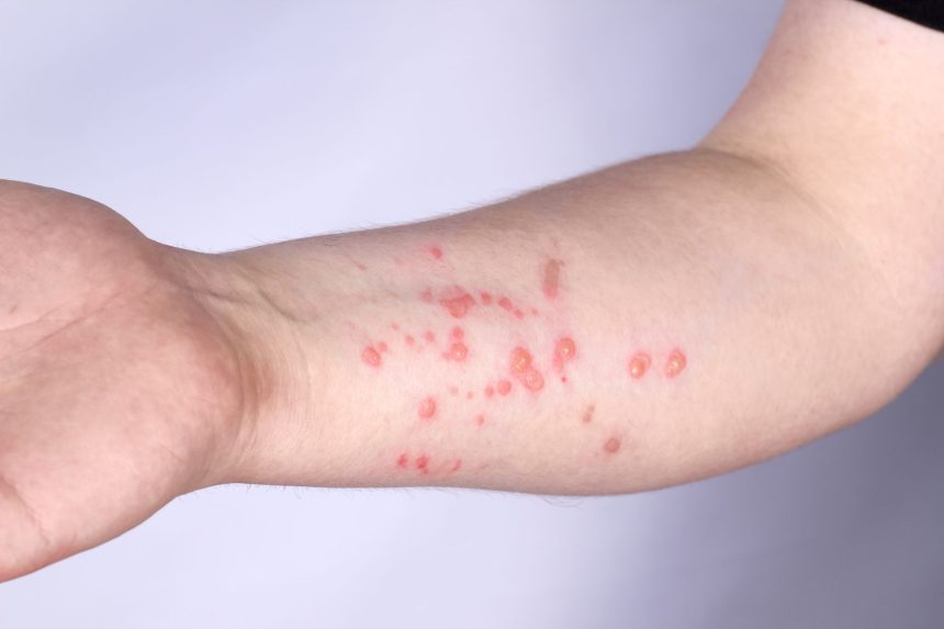 What is Monkeypox