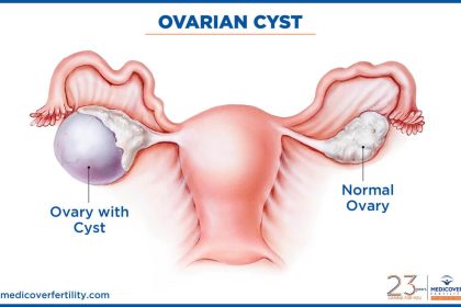 What is a Follicular Cyst