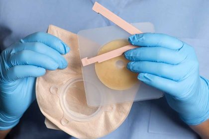 What is a Stoma