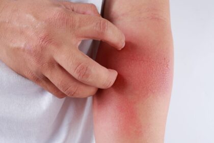 Atopic Dermatitis Treatment