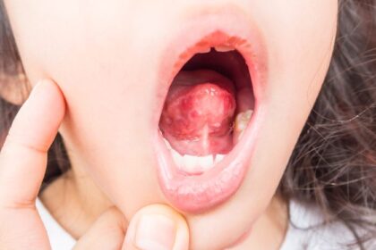Bumps on Back of Tongue - What Causes Them