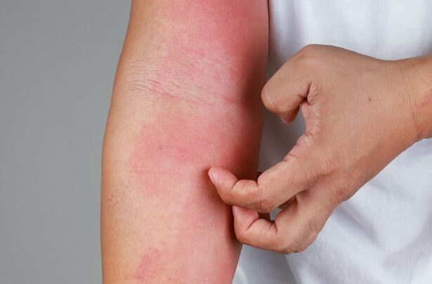 Different Types of Rashes
