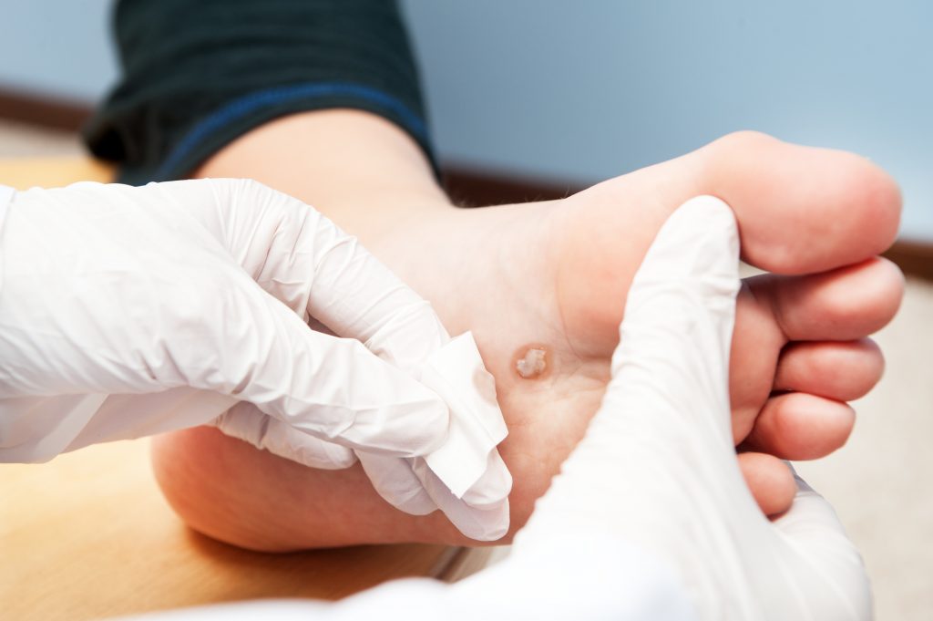 How to Get Rid of Warts