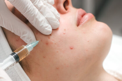 Intralesional Injections - How They Work, What to Expect From Them, and How to Avoid Them