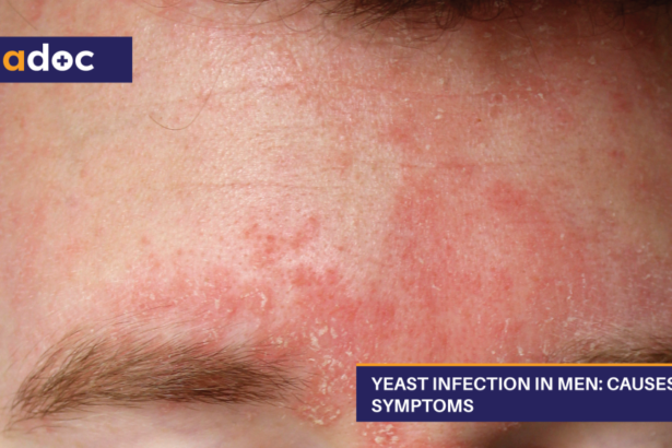 Male Yeast Infection - How to Prevent, Know Symptoms, and Find a Remedy