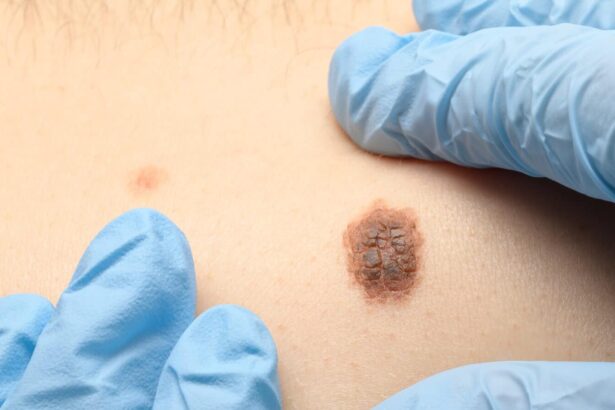 Melanoma Symptoms and Causes