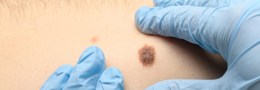 Melanoma Symptoms and Causes