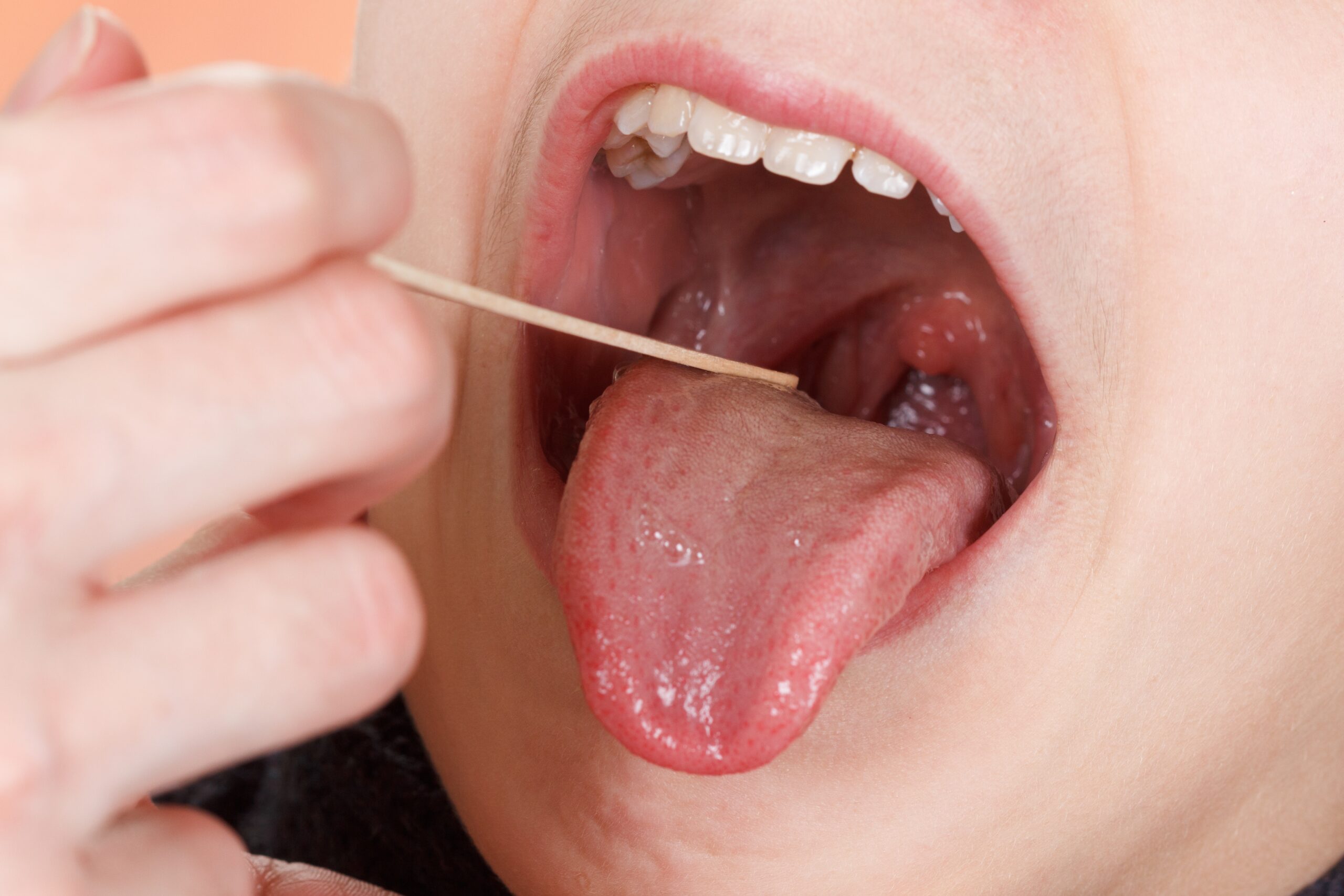 What is Cobblestone Throat? FAQs