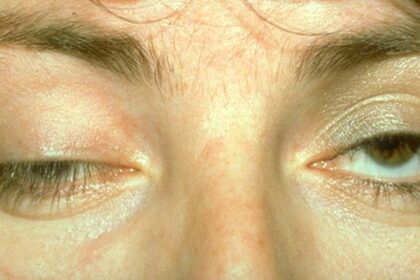 Myasthenia Gravis After Botulinum Toxin Type A Injection